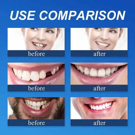 🏆Ends Today: 70% OFF!  🏆2026 Bestselling Product🦷 Fit for a Fresh Smile, Say Goodbye to Wearing Discomfort!🌎