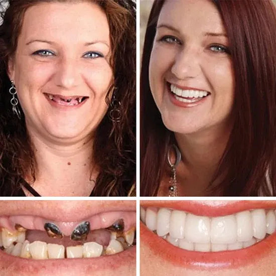 🏆Ends Today: 70% OFF!  🏆2026 Bestselling Product🦷 Fit for a Fresh Smile, Say Goodbye to Wearing Discomfort!🌎